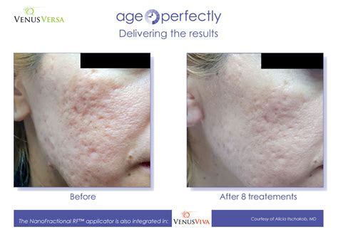 4 Reasons You’ll Venus Viva Skin Resurfacing.